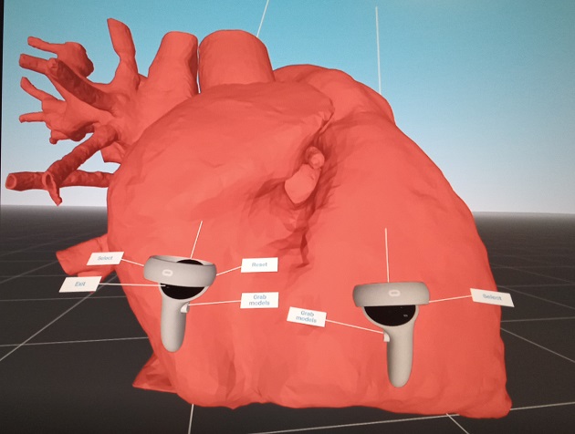 Padova, cardiochirurgia pediatrica applica realtà virtuale nelle cardiopatie congenite