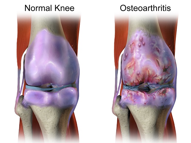 Osteoartrite: finalmente disponibile e accessibile la vera medicina rigenerativa