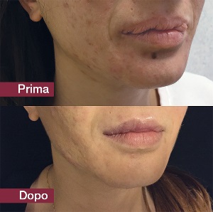 Il silicone liquido nella labbra può sfigurare una persona. Due chirurghi spiegano come rimediare