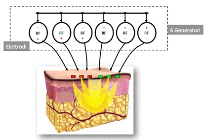 Cellulite, come combatterla con la radiofrequenza