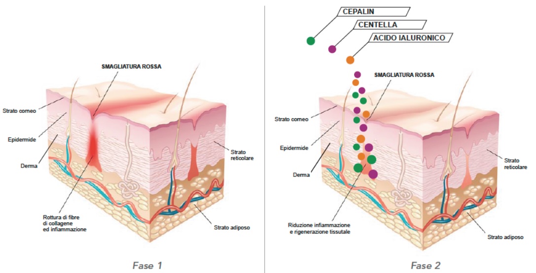 Smagliature meno visibili. Oggi è possibile