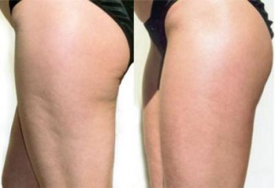 Cellulite. L’efficacia delle creme
