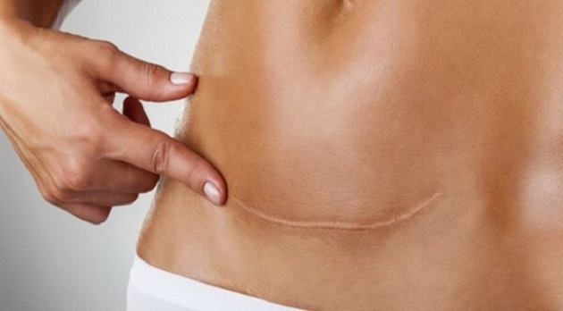 Il botulino e il laser insieme per guarire con più efficacia le cicatrici patologiche