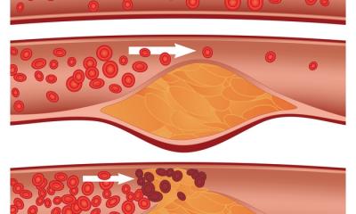 Un nuovo farmaco  per una forma rara di ipercolesterolemia