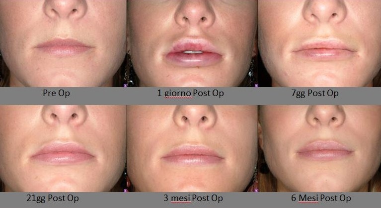 Labbra. Basta con i ritocchi continui
