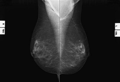 Mammografia. Una conferma della validità dell’indagine