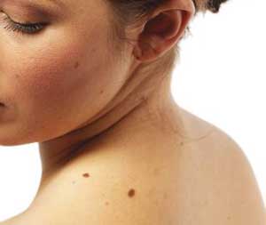 Melanoma cutaneo: ecco le linee guida italiane
