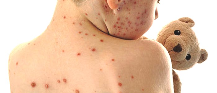 Allerta morbillo in Italia, oltre mille casi nel 2014