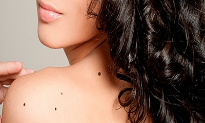 Nevi e melanoma: come si riconosce una neoformazione a rischio