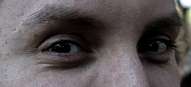 Ringiovanimento del volto: depressioni sott’orbitali.