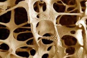 Osteoporosi dietro l’angolo: rischio maggiore di ossa fragili e fratture per i pazienti con malattie infiammatorie