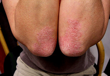 Psoriasi e cheratosi attinica oggi sempre più curabili