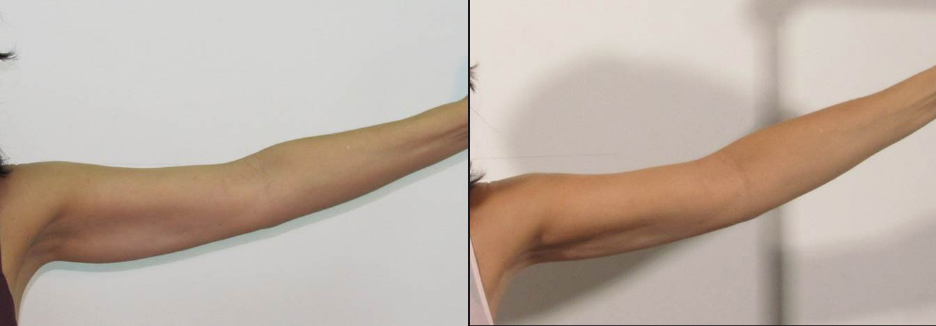 Cellulite. Arriva da Israele Maximus TriLipo