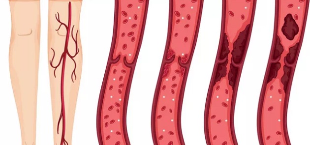 Medicina di precisione per prevenire la trombosi